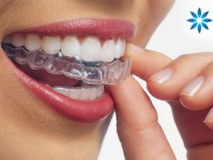 Invisalign