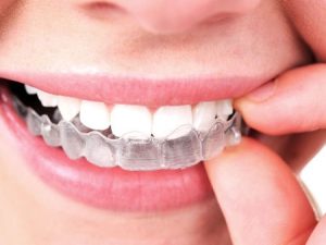 imgi_20_invisalign1